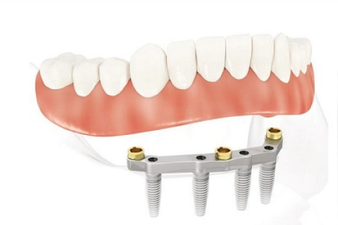 Vì sao giá trồng răng Implant (cấy ghép Implant) lại cao?