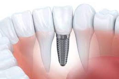 Cấy ghép răng implant tại Nha khoa Tâm Phúc 