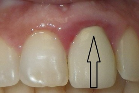 Nướu sưng, đỏ sau bọc răng sứ - Làm sao khắc phục ?