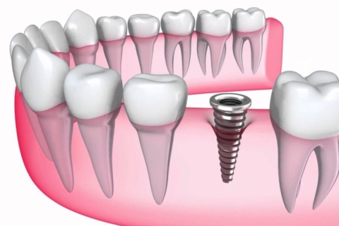 Công nghệ định vị cấy ghép răng Implant: Nhiều lợi ích cho cả bệnh nhân và Bác sĩ