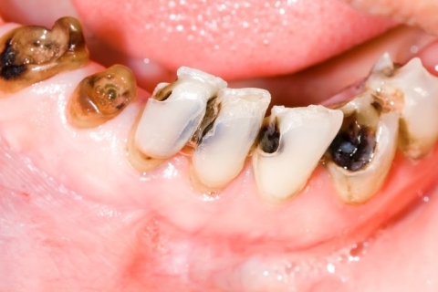 Phương Pháp điều trị sâu răng 