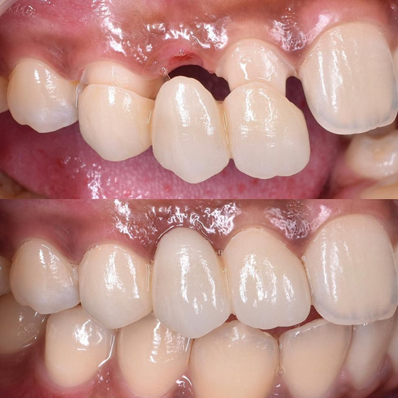 cầu răng cho kết quả với nhiều ưu điểm (hình ảnh điều trị tại Nha khoa Tâm Phúc)